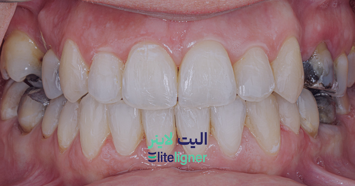 Correction of dental crowding and misalignment