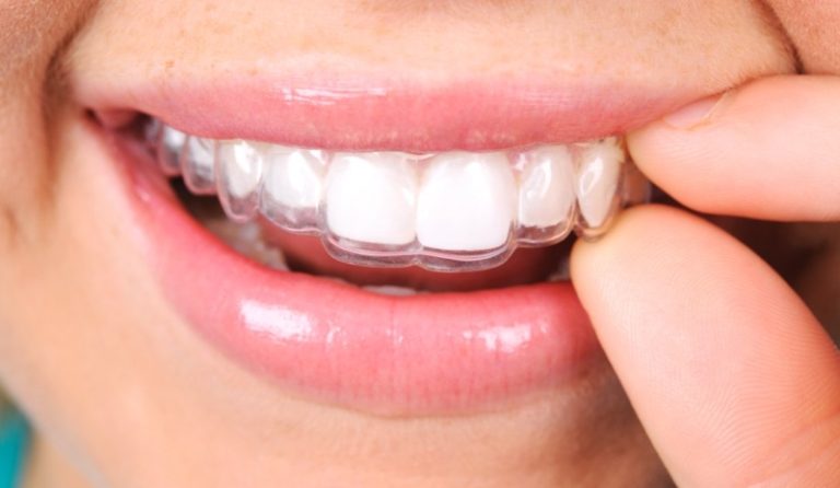 How-effective-are-Invisalign-braces-and-what’s-the-cost