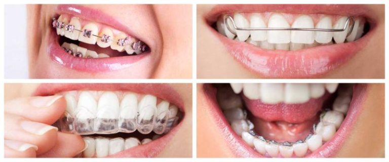 The-Orthodontist---Types-of-Braces