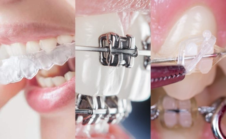 braces