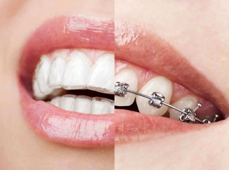 inv-braces